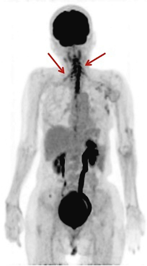 Fig. 4. Fluorodeoxyglucose PET showed abnormal accumulation at both the brachial plexus and cervical spinal cord.