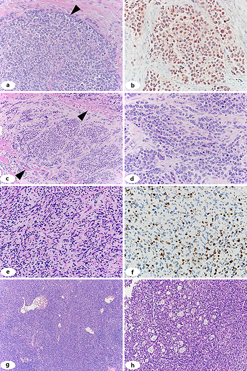 Fig. 1. Histologic and immunohistochemical features of OMF sarcomas. Case 1 shows solid nests of tumor cells with round nuclei and scant eosinophilic cytoplasm (a, 40× objective magnification). Linear arrangement of the tumor cells was focally seen at the edges of the nests of tumor cells (a, arrowhead). Immunohistochemical staining for myogenin demonstrated reactivity in nearly all tumor nuclei (b, 40× objective magnification). Biopsies of Case 2 show nests of tumor cells infiltrating skeletal muscle (c, arrowheads, 20× objective magnifications). The tumor cells show round nuclei and frequent single cells undergoing mitosis or karyorrhexis (d, 40× objective magnification). Case 3 shows spindle cells in a myxoid matrix and relative nuclear pleomorphism compared with Cases 1 and 2 (e, 40× objective magnification). Myogenin immunohistochemical staining highlights less than half of the tumor nuclei (f, 40× objective magnification). The tumor cells of Case 4 show spindle cells arranged in short curved fascicles with scattered dilated and branching vascular spaces (g, 10× objective magnification). Focal areas of the tumor demonstrate intermixed epithelial elements (h, 20× objective magnification).