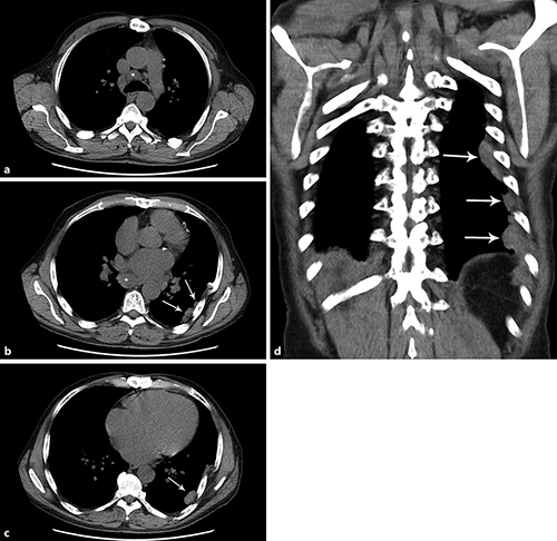 Fig. 1. Axial non-contrast enhanced CT images in a mediastinal window setting at the level of the mediastinum demonstrate enlarged paratracheal (a) and subcarinal (b) lymph nodes (asterisk). Note the small pleural nodules in the left hemithorax (white arrows). The image of the lower thoracic region (c) shows the deformity of the rib cage and a larger well-delineated lobular pleural nodule (white arrow). The extent of the pleural abnormalities is best appreciated on the coronal reformatted image (d) showing numerous pleural nodules up to 45 mm in size. Note the absence of the spleen under the left diaphragm (arrows).