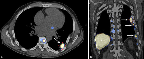 Fig. 2. SPECT/CT images after injection of 185 MBq 99mTc-phytate (sulfur colloid scintigraphy). Axial (a) and coronal (b) fused images show physiological tracer uptake in the reticuloendothelial system of the bone marrow, liver (asterisk) as well as in the pleural nodules (white arrows), confirming the diagnosis of thoracic splenosis.