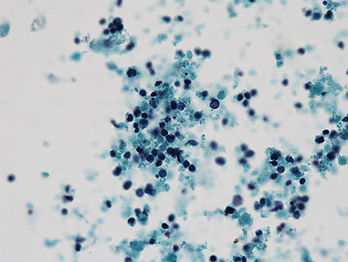 Fig. 1. Preoperative urinary cytology findings reveal clusters of small tumor cells resembling neuroendocrine carcinoma (×40).