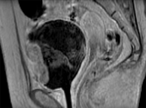 Fig. 2. MRI (sagittal section) before the initiation of transurethral resection of bladder tumor shows a broad-based solitary nodular tumor on the anterior wall of the bladder with a diameter of 54 × 50 × 24 mm, indicating extracystic invasion, and no evidence of distant or lymph node metastasis.