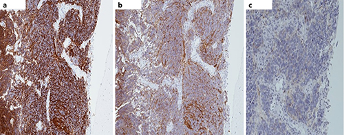 Fig. 3. Immunohistochemical staining for cluster of differentiation 56 (a) (original magnification: ×10), synaptophysin (b) (×10), and chromogranin A (c) (×10) of small-cell carcinoma of the bladder.