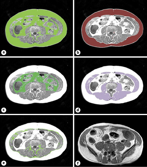  Segmentation of body composition based on cross-sectional area (CSA) measurements at the L3 inferior endplate level in MRE (a-e). a Total adipose tissue (TAT). b Subcutaneous adipose tissue (SAT). c Visceral adipose tissue (VAT). d Skeletal muscle tissue (SMT). e Intramuscular adipose tissue (IMAT). f Creeping fat (CrF), T1-weighted MRE image shows fatty deposition along the mesenteric border of inflamed bowel segment.