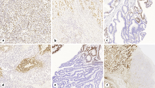 The Day-To-Day Practice of MMR and MSI Assessment in Colorectal ...