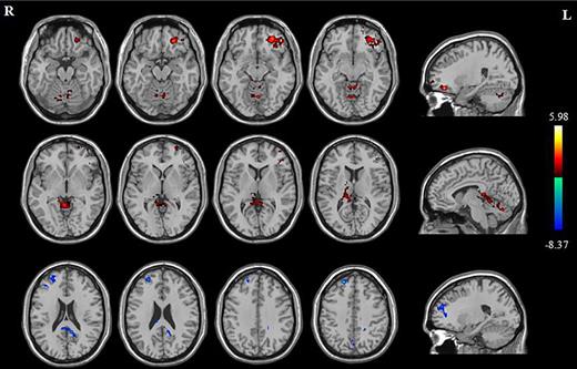 Comparison of FA values in real group before and after treatment. Locations with increased FA values compared with baseline were depicted in red, and locations with decreased FA values compared with baseline were depicted in blue. R, left hemisphere; L, right hemisphere; AlphaSim correction; p < 0.05; cluster size >395.