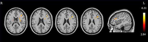 Comparison of FA values between real group and sham group after treatment. Location with FA values of real group higher than sham group was depicted in yellow. R, left hemisphere; L, right hemisphere; AlphaSim correction; p < 0.05; cluster size >388.