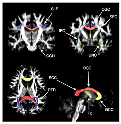 Fig. 1. FA maps with color overlays showing the white matter tracts included in the analysis. Tracts were segmented by atlas analysis. The evaluated tracts were the uncinate fasciculus (UNC), SLF, SFO, IFO, PTR, and the fornix (Fx). The corpus callosum was segmented into three portions: the genu, body, and splenium (GCC, BCC, and SCC). The cingulum was segmented into the portion underlying the cingulate cortex (CGC) and a parahippocampal portion (CGH).