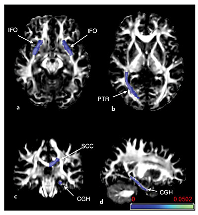 Fig. 4. Axial (a, b), coronal (c), and sagittal (d) views of FA maps with color overlays of white matter structures with significant associations between DTI metrics and particular neuropsychological tests as listed in table 4. The DRS-2 memory subscore was associated with AD of the IFO bilaterally (a), and the right PTR was associated with the memory score and letter fluency (b). Other fluency subscores were associated with diffusion properties of the splenium of the corpus callosum (SCC) (c) and the parahippocampal portion of the left cingulum (CGH) (d). Scale denotes uncorrected p value, and thresholds below 0.01 are shown.
