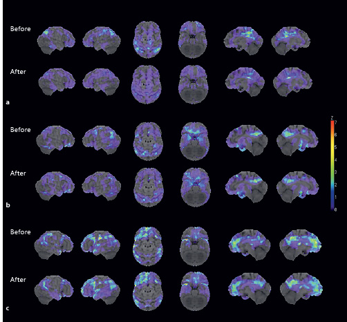 Fig. 3. The 3D stereotactic surface projection images of hypometabolism before and after therapy in 3 patients in Group A. a The patient was male and 77 years of age at the time of the first FDG-PET examination. He did not have amnesia (Clinical Dementia Rating [CDR]: 0; Mini-Mental State Examination [MMSE] score: 29). After diagnosis of mycobacterium avium complex (MAC), 450 mg/day of rifampicin was administrated for 12 months. The second FDG-PET was performed 24 months after the first FDG. An increase of FDG uptake was observed in the posterior cingulate cortex (PCC) and the parietal association cortex. The CDR and MMSE score of the patient did not change. b The patient was female and 74 years of age at the time of the first FDG-PET examination. She was slightly amnestic but had no problems in daily life (CDR: 0.5; MMSE score: 26). After diagnosis of MAC, she completed 12 months of therapy with 450 mg daily of rifampicin. The second FDG-PET was performed 24 months after the first FDG. An increase of FDG uptake was clearly observed in the PCC and slightly in the parietal association cortex. The CDR of the patient remained 0.5, but the MMSE score increased to 28. c The patient was male and 85 years of age at the time of the first FDG-PET examination. He was slightly amnestic but had no problems in daily life (CDR: 0.5; MMSE score: 25). After diagnosis of MAC, he completed 12 months of rifampicin therapy. The second FDG-PET was performed 36 months after the first FDG. FDG uptake was not changed obviously. The CDR and MMSE score of the patient did not change.
