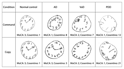Clock Drawing in the Montreal Cognitive Assessment: Recommendations for ...