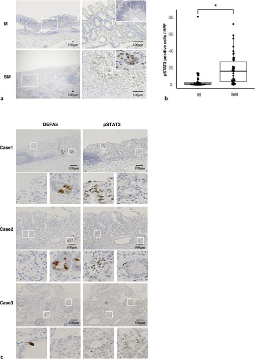 Phosphorylated STAT3 accumulates during early SMGC. a Representative images of immunohistochemical (IHC) staining for phosphorylated STAT3 (pSTAT3) in an intramucosal gastric cancer (IMGC) and an early submucosal-invasive gastric cancer (SMGC). M and SM indicate IMGC and SMGC, respectively. Scale bar = 100 μm. b Dot and box plot for the pSTAT3-positive cells in IMGCs (n = 50) and SMGCs (n = 50). M and SM indicate IMGC and SMGC, respectively. The horizontal line in the middle of each box indicates the median, and the top and bottom borders of the box mark the 75th and 25th percentiles, respectively. *p < 0.05. c Representative images of IHC staining for pSTAT3 and DEFA5 in serial sections. The regions where pSTAT3 or DEFA5 were expressed are magnified. Scale bar = 100 μm.