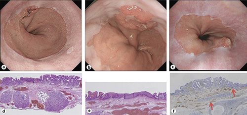  Endoscopic and histological findings of EGJ adenocarcinoma. a–c It is sometimes difficult to distinguish Barrett’s adenocarcinoma from gastric cardiac adenocarcinoma endoscopically. d The presence of esophageal glands; (e) squamous island within the lesions; (f) duplication of the muscularis mucosae under the lesions (arrows).