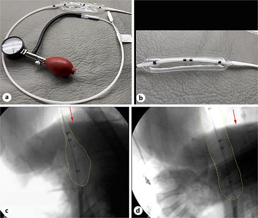 Pneumatic balloon dilation. a A 30-mm pneumatic balloon catheter connected to an inflation bulb and pressure gauge. b Close-up view of the inflated balloon, clearly showing the fluoroscopic markers (black bands). c Fluoroscopic image demonstrating the balloon advanced across the GEJ (diaphragm indicated by red arrow). The balloon is partially inflated, showing the characteristic “waist” (outlined in yellow). d Fluoroscopic image showing complete balloon inflation with the previously noted waist obliterated, again highlighting the diaphragm (red arrow).
