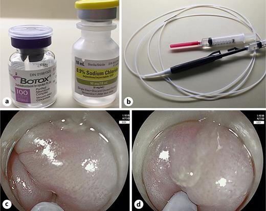 Botulinum toxin injection. a Botulinum toxin vial and preservative-free saline. b Injection catheter prepared and primed with a total of 4 cc of the botulinum toxin-saline mixture, allowing for injection of 25 units into each quadrant. c Endoscopic view demonstrating catheter with the injection needle deployed prior to injection. d Endoscopic view showing deep intramuscular injection at the lower esophageal sphincter (LES).