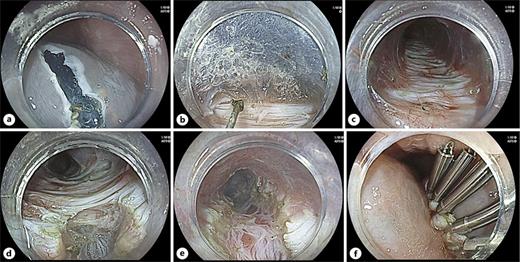 Peroral endoscopic myotomy. a Mucosal incision approximately 1.5–2 cm in length. b Submucosal tunnel creation initiated. c Completed submucosal tunnel. d Ongoing selective circular muscle myotomy. e Completed selective circular myotomy. f Closure of the mucosal entry site using endoscopic clips.