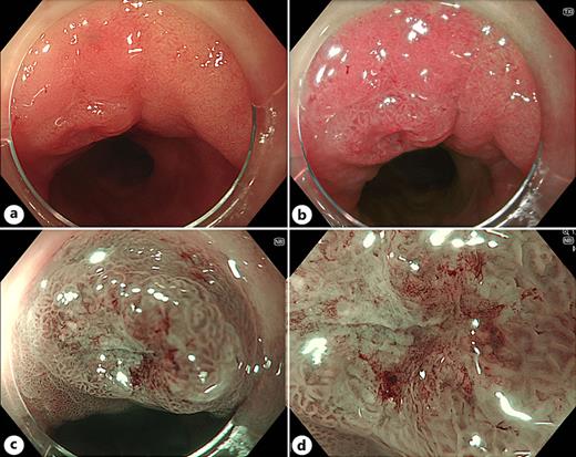 A small nodule within BE (pT1a adenocarcinoma) seen on WLE (a), TXI (b), NBI (c), and M-NBI (d). The lesion is more conspicuous on TXI, with the altered vascularity in the centre of the nodule well demonstrated on M-NBI.