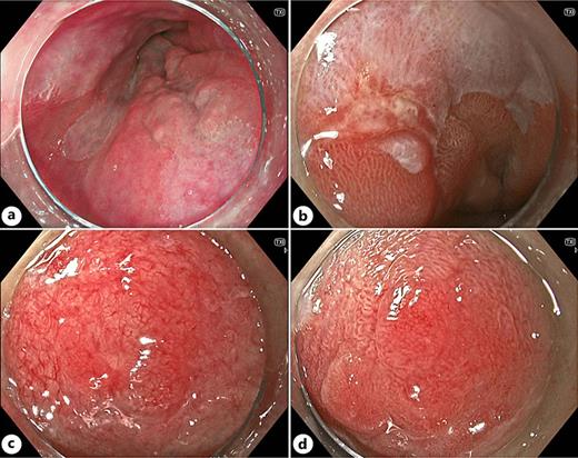 Endoscopic features of identified “areas of concern.” a Nodularity. b Depression. c Altered vascularity. d Altered pit pattern.