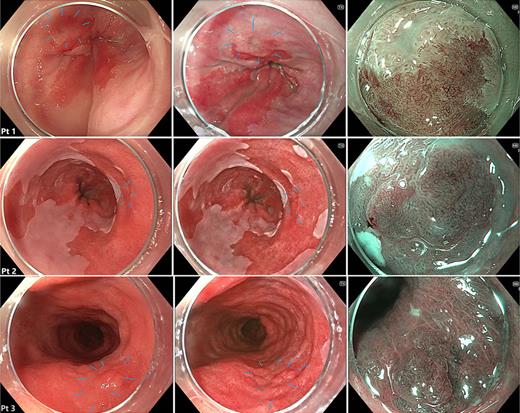 Three discrepant cases of adenocarcinoma (patient 1) and high-grade dysplasia (patients 2 and 3). Views on WLE on the left, TXI in the centre and M-NBI on the right. Lesions marked by blue lines on the WLE and TXI images, each of which was more conspicuous when viewed on TXI than WLE.