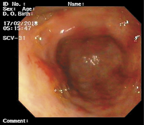 Fig. 1. Watermelon stomach.