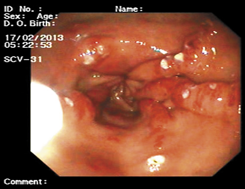 Fig. 2. Radial extension of red stripes from the pylorus of the stomach.