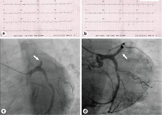 Fig. 1. a Initial ECG showing anterior wall STEMI. b ECG after coronary angioplasty before hospital discharge. c Coronary angiogram showing a total block of LAD (arrow). d LAD flow restored after primary PCI (arrow).