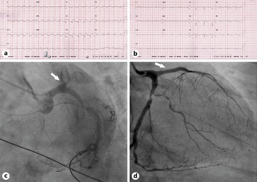 Fig. 2. a Initial ECG showing anterior wall STEMI due to stent thrombosis. b ECG after primary coronary angioplasty for stent thrombosis. c Coronary angiogram showing LAD stent thrombosis (arrow). d LAD flow restored after thrombectomy and balloon coronary angioplasty for stent thrombosis (arrow).