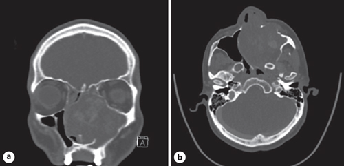 Coronal (a) and axial (b) computerized tomography (CT) showed left maxillary mass infiltrating into nasal cavity with a significant displacement of the nasal septum to the right side.