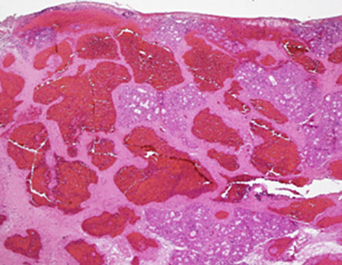 Histopathological section of our patient showed irregular dilated congested blood vessels transverse through the polypoid mass glandular lobules.