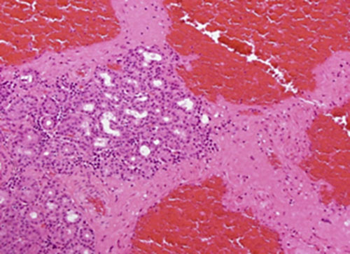 Histopathological section of our patient showed cavernous vascular channels lined by endothelial cells with irregular fibromuscular walls.