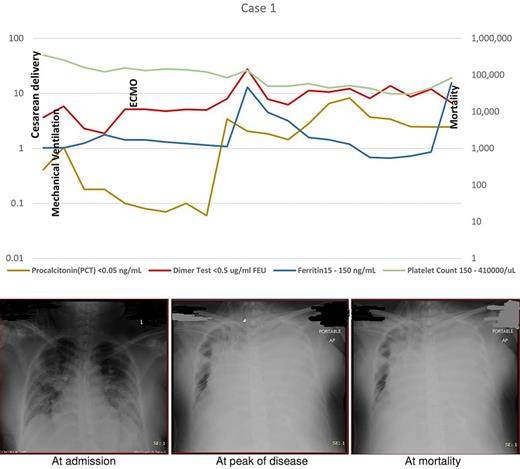 Case 1: Timeline with investigations (the primary Y axis [left] shows dimer and procalcitonin values in the logarithmic scale starting from 0.1, the secondary Y axis [right] shows platelet count and ferritin in the logarithmic scale starting from 1). Chest X-ray findings. At admission, peak disease, at mortality.