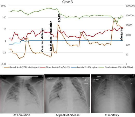 Case 3: Timeline with investigations (the primary Y axis [left] shows dimer and procalcitonin values in the logarithmic scale starting from 0.1, the secondary Y axis [right] shows platelet count and ferritin in the logarithmic scale starting from 1). Chest X-ray findings. At admission, peak disease, at mortality.