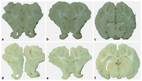 Representative pathology from injured (a–c) and uninjured (d–f) animals. a, d Slices from the frontal lobe of the piglet. Note white matter injury (circled area) in the deep white matter of the injured animal. b, e Slices from the parietal lobe, demonstrating extensive deep white matter injury in the injured animal with a small amount of white matter injury in the uninjured animal. c, f Brain stem with areas of white matter injury and infarction (shaded area) in the injured animal.
