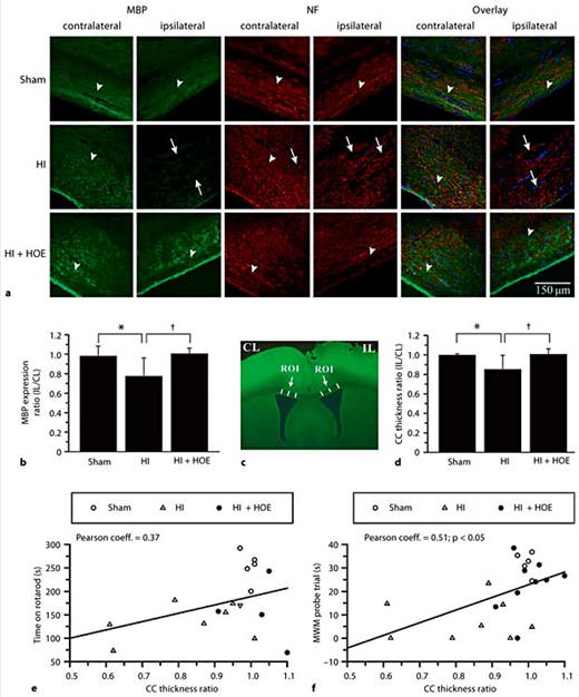 Fig. 3. HI-induced loss of MBP and NF expression in the ipsilateral CC. Changes in MBP and NF protein expression after HI were examined by immunohistochemical staining in the contralateral and ipsilateral CC of ex vivo brains at P90 after HI. CL = Contralateral; IL = ipsilateral. * p < 0.05 sham vs. HI; † p < 0.05 HI vs. HI + HOE. a Representative images of MBP and NF stainings are shown from each group. Arrowheads: abundant MBP and NF expression. Arrows: reduced MBP and NF expression. TO-PRO-3 Iodide used for nuclear staining. b MBP expression is expressed as the ratio of ipsilateral to contralateral values in sham, HI and HI + HOE animals (n = 5–9). c Three ROI in the CC were selected and the thickness of the CC measured in each brain and expressed as a mean value. d CC thickness was expressed as the ratio of the ipsilateral to contralateral mean values in sham, HI and HI + HOE animals. e Correlation of CC thickness ratio with time spent on rotarod. f Correlation of CC thickness ratio with time spent in the training quadrant (MWM probe trial).