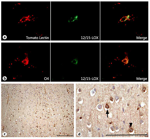 Fig. 1. 12/15-LOX expression in controls. a 12/15-LOX expression shows colocalization with the microglial marker tomato lectin in the white matter of a control case at 34 PC weeks. Magnification ×40. b A rare 12/15-LOX-expressing O4 cell is detected in the white matter of a control case at 37 PC weeks. Magnification ×40. c, d Scattered neuronal cells throughout all layers express 12/15-LOX in a control case at 40 PC weeks. Neurons are shown at low magnification (c, scale bar = 200 μm) and at high magnification (d, scale bar = 100 μm). c 12/15-LOX expression is shown in pyramidal neurons (arrow) and granular neurons (arrowhead).