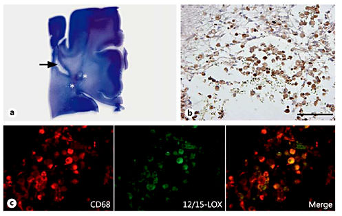 Fig. 2. 12/15-LOX expression in macrophages of the focal necrotic lesion of PVL. a Shown is a representative hematoxylin-eosin-stained section of a posterior frontal section of PVL with a macrocyst (arrow) and microcystic lesions (asterisks) in the periventricular white matter. b 12/15-LOX is expressed in the macrophages and/or ameboid microglia of the microcystic lesion as seen by DAB staining. Magnification ×20 (scale bar = 200 μm). c Macrophages/ameboid microglia within the focal lesion show colocalization with macrophage/microglia marker CD68 and 12/15-LOX. Magnification ×40.