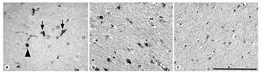Fig. 3. 12/15-LOX expression in the diffusely gliotic lesion of PVL. All images are shown at a magnification of ×40, scale bar = 100 μm. a 12/15-LOX is expressed in glial cells of the diffusely gliotic lesion in a PVL case at 40 PC weeks. Arrows indicate cells with the morphological appearance of microglia. The arrowhead indicates a cell with the appearance of an OL. b 12/15-LOX expression is detected in scattered nuclei (asterisks) of cells in the gliotic white matter of a PVL case at 39 PC weeks. c There is no detectable expression of 12/15-LOX in the white matter of a control case at 40 PC weeks.