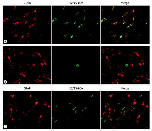 Fig. 5. 12/15-LOX expression in reactive microglia and reactive astrocytes of the diffuse component. All images are shown at a magnification of ×40. a 12/15-LOX is expressed in a population of CD68-positive activated microglia in the diffuse component of PVL. b There is a population of CD68-positive activated microglia in the diffuse component of PVL that does not show colocalization with 12/15-LOX. Based on morphology, the 12/15-LOX-positive/CD68-negative cell is likely to be a mature OL. Both a and b are from a PVL case at 40 PC weeks. c There is no colocalization of 12/15-LOX with the reactive astrocyte marker GFAP in a PVL case at 38 PC weeks.
