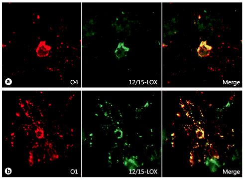Fig. 6. 12/15-LOX expression in OL of the premyelinating (O4) and immature (O1) stages. a There is colocalization of 12/15-LOX with the O4 marker of premyelinating OLs in a PVL case at 30 PC weeks. b There is colocalization of 12/15-LOX with the O1 marker of immature OLs in a PVL case at 30 PC weeks.