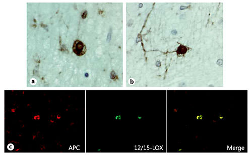 Fig. 7. 12/15-LOX expression in mature OLs. a, b 12/15-LOX is expressed in cells with the morphological appearance of mature OLs as determined by DAB staining in a PVL case at 38 PC weeks. c 12/15-LOX is colocalized with the mature OL marker APC in a PVL case at 33 PC weeks. Magnification ×40.