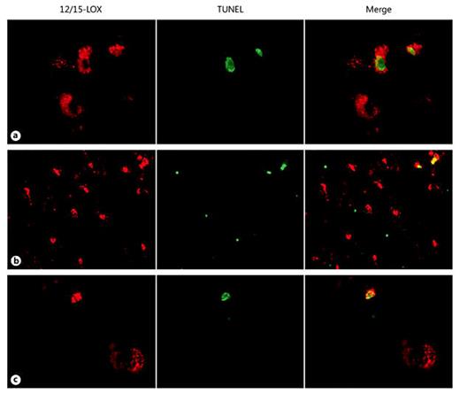 Fig. 8. Relationship between TUNEL-positive cells and 12/15-LOX expression. a In a case at 39 PC weeks, 2 TUNEL-positive cells show colocalization with cytoplasmic 12/15-LOX expression. Also shown is a 12/15-LOX-positive cell negative for TUNEL. Magnification ×40. b In a case at 41 PC weeks, a low-power (×20) magnification shows cells positive for TUNEL only proximal to cells positive for 12/15-LOX. Also shown are 2 TUNEL-positive cells with colocalization of cytoplasmic 12/15-LOX expression. c In a case at 39 PC weeks, a TUNEL-positive cell is shown with nuclear colocalization of 12/15-LOX. Also shown is a 12/15-LOX-positive cell negative for TUNEL. Magnification ×40.