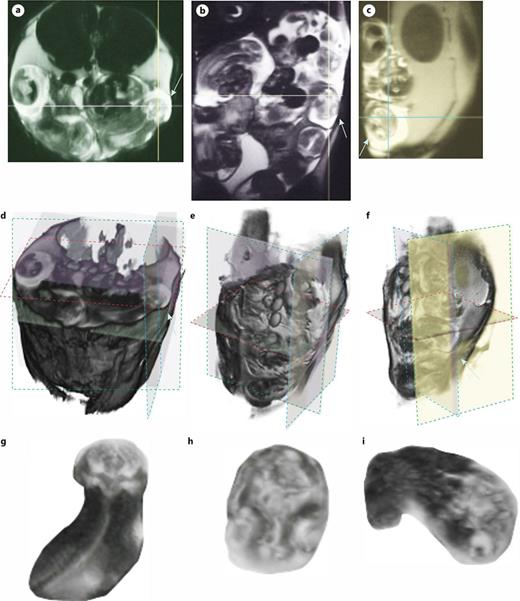 Obtaining 3-dimensional perspective of the fetus. T2-weighted MRI structures were analyzed in 2 dimensions (intersecting lines) in (a–c), with axial (a), coronal (b), and sagittal (c) p lanes identifying a fetal brain (arrow). Utilizing 3D slicer intricate three-dimensional reconstructions were generated for the axial (d), coronal (e), and sagittal (f) planes. X, Y, Z planes are outlined in red, green and blue dotted lines respectively. The final close-up shows the fetus from the axial (g), coronal (h), and sagittal (i) perspectives.