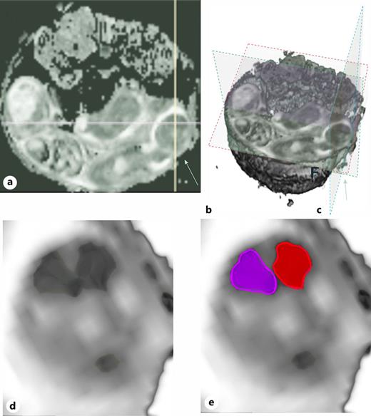 Obtaining left and right hemispheric ADC. a 2-Dimensional ADC image captured in the axial plane of fetal brain (arrow). b 3-Dimensional reconstruction showcasing the intricate structure of the ADC image utilizing 3D Slicer. X, Y, Z planes are outlined in red, green, and blue dotted lines respectively. c This results in up-close depiction of the ADC structure. Now, the hemispheres can be delineated in (d) as right (purple) and left (red) hemispheres (e) with the aid of GIMP 2.10.3.