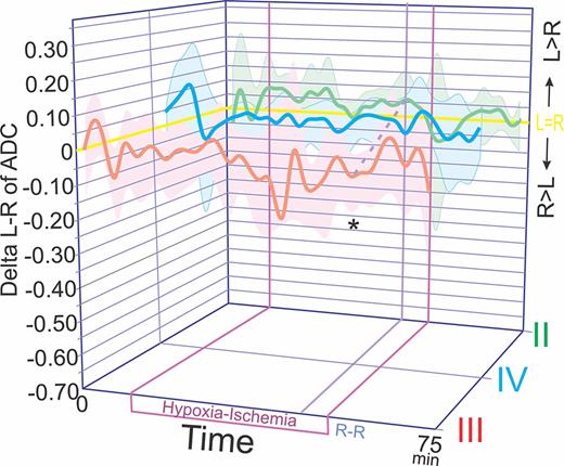 Delta L-R ADC values. Y-axis shows delta L-R ADC values, curves are smoothened out for clarity. X-axis shows time. Z-axis shows patterns of injury. Pattern II green, III red, IV blue. Means and 95% confidence intervals of delta L-R ADC are shown. Patterns are offset for showing in three dimensions. The yellow line is at zero where L = R for ADC values. +ve values: L>R, ‒ve values: R>L. Only at 33 min after start of H-I, there was a significant difference between groups (*p < 0.05, Wilcoxon Rank Sum test and ANOVA, with post hoc Tukey’s studentized range test showing III different from II and IV). Dashed purple line is for reader to reference same timepoint. The UCI is also below 0 for Pattern III at this timepoint, clearly indicating right-favoring ADC. By repeated measures ANOVA, delta L-R ADC change over the entire timeline shows no significant difference between patterns.