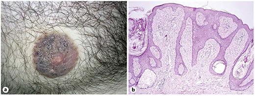 Fig. 1. a Diffuse hyperkeratosis of the nipple and areola. Keratin pearls are also noticeable on the surface. b Slight hyperkeratosis, follicular plugging, acanthosis and prominent papillomatosis. There is no neoplastic infiltration in the papillary dermis. HE. ×100.