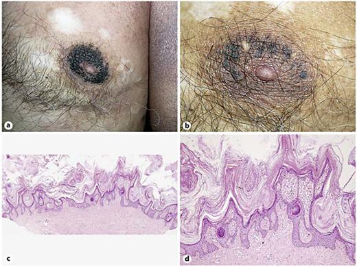 Fig. 2. a Dark brown verrucous thickening of the areola associated with plaques of MF on the upper arm. b Substantial improvement of the hyperkeratosis of the areola after PUVA therapy for MF. c, d Histopathology shows very prominent hyperkeratosis, verruciform acanthosis and papillomatosis. There is no infiltration in the papillary dermis. HE. c ×40. d ×100.