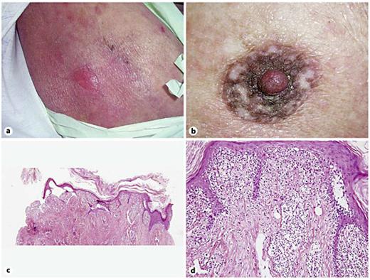 Fig. 3. a Erythematous plaques and an erosion on the thigh representing bullous MF. b Infiltrated plaque covered with hyperkeratosis located on the nipple and areola. c, d Hyperkeratosis is prominent. The epidermis is thinned and separated from the dermis due to biopsy trauma. There are numerous lymphocytes in the junctional area, which were interpreted as MF involvement of the areola. HE. c ×40. d ×200.