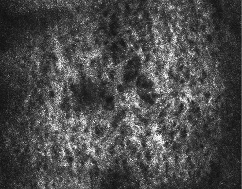 Fig. 1. Superficial dermis: SE in a patient (in vivo RCM). RCM, -reflectance confocal microscopy; SE, solar elastosis.
