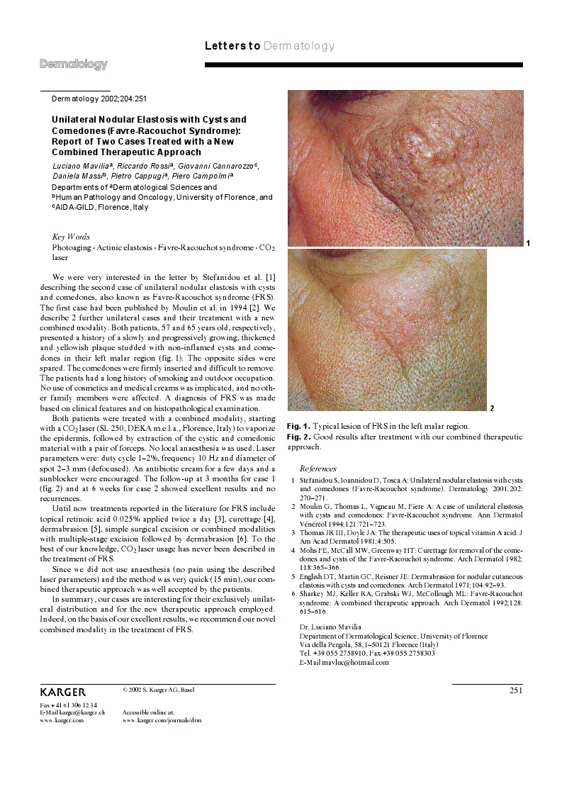 Unilateral Nodular Elastosis with Cysts and Comedones (FavreRacouchot