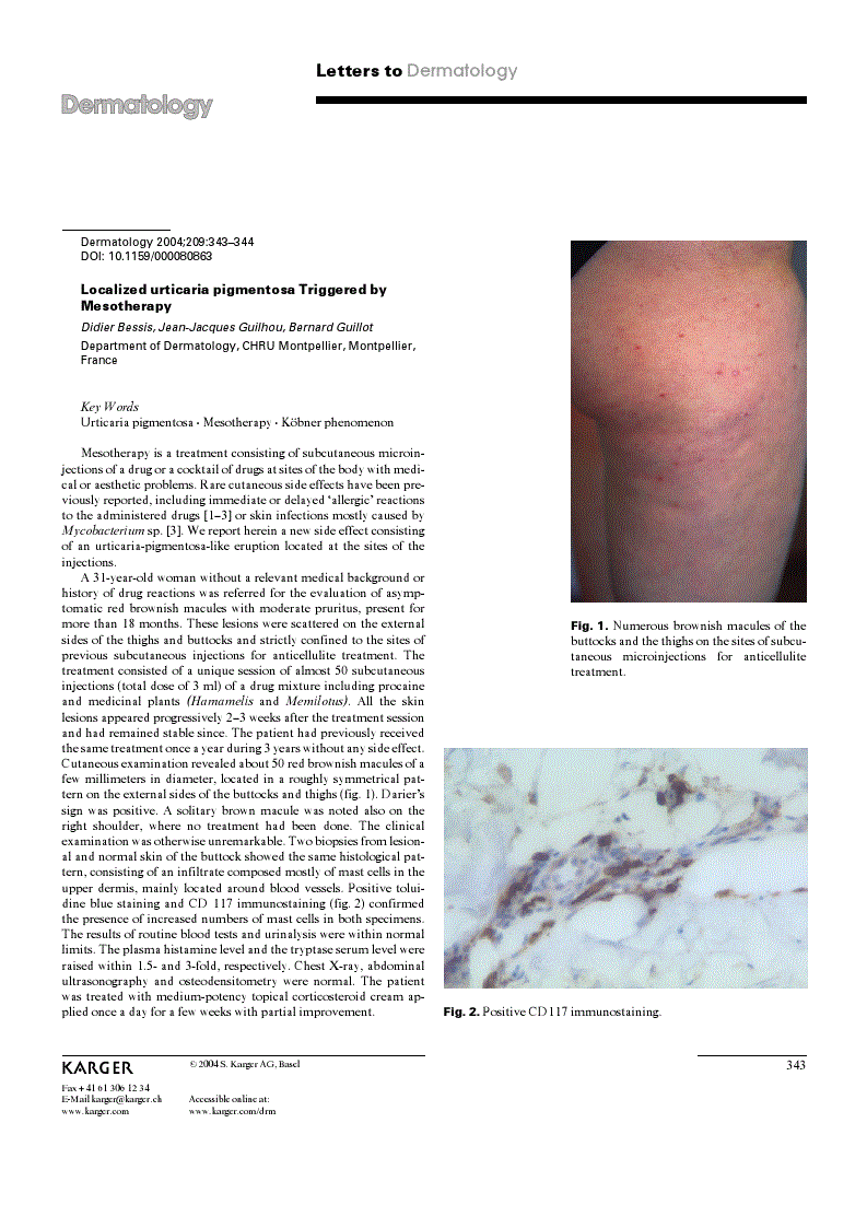 First page of Localized urticaria pigmentosa Triggered by Mesotherapy
